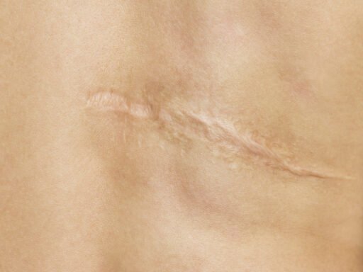 Scar after operation on back of women on white background
