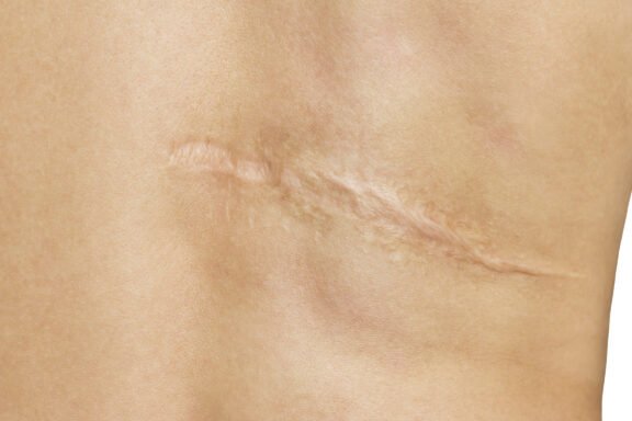 Scar after operation on back of women on white background