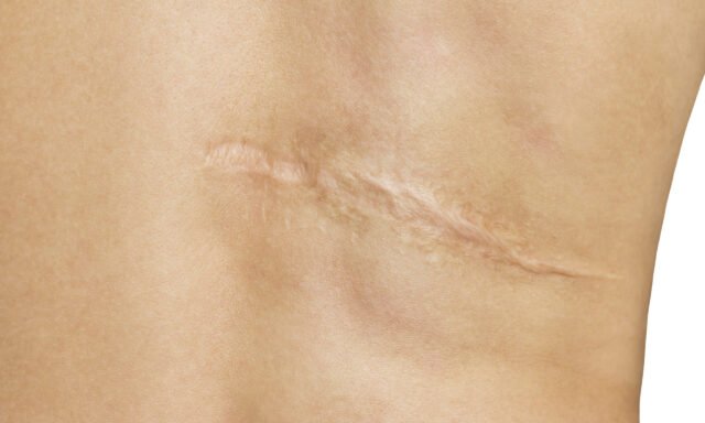 Scar after operation on back of women on white background